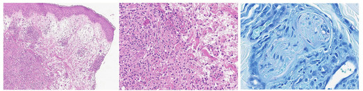 Abb. 2a, b, c Die Hautbiopsie zeigt ein ausgeprägtes Ödem der papillären Dermis mit oberflächlichen und tiefen entzündlichen Infiltraten, die reich an Histiozyten und Neutrophilen sind (Hämatoxylin und Eosin, 4x, 100x), sowie einzelne säurefeste Stäbchen um einen Nerven (Ziehl-Neelsen-Färbung 400x)