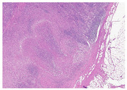 Abb. 3 Granulomatöse nekrotisierende Lympha- denitis (Hämatoxylin und Eosin, 4x)