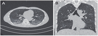 Abb. 1 A+B   CT-Thoraxaufnahmen eines spät diagnostizierten Menschen mit  HIV: atypische Pneumonie beidseits, mit milchglasartigen Infiltraten  (A + B), vor Diagnose und Therapie einer Pneumocystis  jiroveci-Infektion