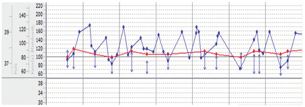 Abb. 4  Ausschnitt Fieberkurve des spät diagnostizierten Menschen mit  HIV, ab Tag 18 nach Therapiebeginn der Pneumocystis jiroveci-Pneumonie   sowie Tag 8 nach ART-Start. Skalierungen: links – Körpertemperatur  (blaue Kurve) in [°Celsius], mitte – Pulsfrequenz (rote Kurve) in [Schläge/Minute], rechts – Blutdruck (schwarze doppelendende Pfeile)  in [mmHg nach Riva-Rocci]