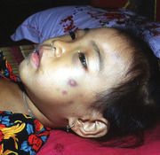 Abb. 3  Dengue-hämorrhagisches Fieber bei einem vierjährigen Mädchen in Kambodscha