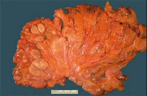 Abb. 1: Mycobacterium avium complex (MAC) führt zu großen gelblichen Knoten, hier mesenteriale Lymphknoten, die vollgepackt mit Mykobakterien sind