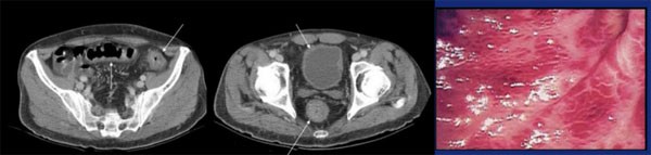 Abb. 1: CMV-Kolitis. Pfeil: Schleimhautentzündung mit verdickter Mukosa im Colon transversum, Sigmoid, Rektum und Blase