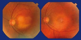 Abb. 2: CMV-Retinitis vor und nach Therapie 