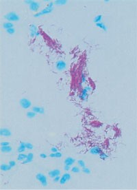 Abb. TB-Bakterien