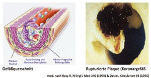 Atherosklerotischer Plaque mit Ruptur 