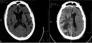 Abb. 2: Hirnmetastase bei Bronchialkarzinom (zunächst unauffälliger CCT-Befund bei BC Diagnose, dann große Metastase 7 Monate später)