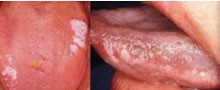 Abb. 2: Typisches Bild einer manifesten oralen Haarleukoplakie am lateralen Zungenrand 