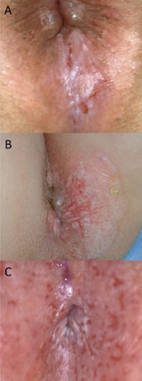 Abb. 1: Leukoplakie, Histologie negativ (A), Plattenepithel-Ca in situ (M. Bowen) (B), Adeno-Ca in situ (M. Paget) (C) 