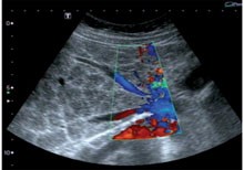  Abb. 6: links: Sonogramm der Gallenblase: echodichte Gallenblasenwandverdickung, rechts: Sonogramm des linken Leberlappens: echogene portale Wandverdickung „Tonpfeifenstielfibrose