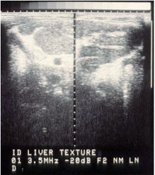 Abb. 7: Netzwerkfibrose der Leber 