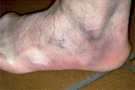 Fibroide Knoten an der Fußsohle derselben Patientin 3 Fibroide Knoten an der Fußsohle derselben Patientin  --  2 ACA der Knöchelregion und des Fußes bei einer 53-jährigen Patientin drei Jahre nach Zeckenstich und nachfolgendem Erythema migrans, welches homöopathisch behandelt wurde. 