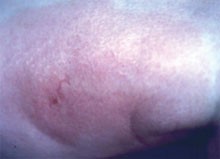 Kriebelmückenstich mit derber, plattenförmiger Infiltration der Haut