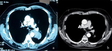 Abb. 1 a+b  (a) großes Adenokarzinom des linken Lungenunterlappen (cT2aN2) bei Pat. mit funktioneller Inoperabilität für eine primär erforderliche Pneumonektomie; (b) Tumorrückbildung nach 4 Zyklen neoadjuvanter Chemotherapie; nachfolgende erfolgreiche Lobektomie; postoperatives Stadium ypT1a N1.