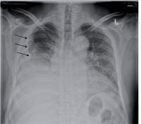 Abb. 2a  ausgedehnte tumoröse Verschattung links mit Verbreiterung des Mediastinum und Pleuraerguss¬