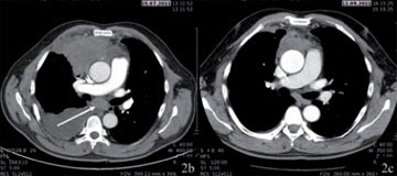 Abb. 2b+c  (b) zugehöriges CT: ausgedehntes kleinzelliges Karzinom im vorderen oberen Mediastinum mit riesigen subcarinalen mediastinalen Lymphknotenmetastasen¬und malignem Pleuraerguss rechts (cT4N3M1a); (c) Tumorrückbildung nach 4 Zyklen Chemotherapie. 