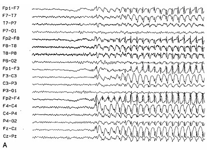 Abb. 3  Generalisierte spikes/waves während eines generalisierten epileptischen Anfalls