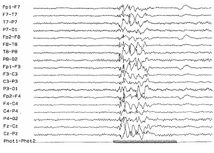 Abb. 4  Generalisierte spikes/waves unter Photostimulation als Provokationsmethode