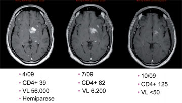 Abb. 5  33jähriger Patient aus Kamerun. HAART mit geboostertem Atazanavir plus Tenofovir/Emtricitabin. Für die zerebrale Toxoplasmose Sulfadiazin 4x 2 g, Daraprim 2x 50 mg, Atovaquone 2x 1,5 g 