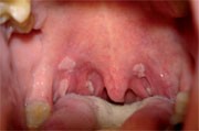 Abb. 1  Multiple orale Condylome