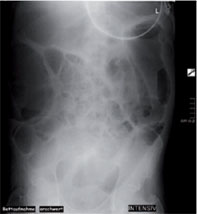 Abb. 1 CDAC Megakolon: Abdomenübersicht (Aufnahme im Bett der
                      Intensivstation). Deutliche Distension des Kolons im rechten oberen Quadranten des Bauches.