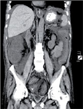 Abb. 2  CDAC Megakolon: CT-Abdomen des gleichen Patienten. Deutliche Wandverdickung von Kolon ascendens und descendens zu erkennen.