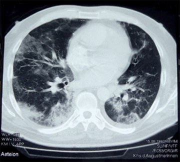 Abb. 3  PcP-, CMV- und  H1N1-Koinfektion: CT Thorax mit flächigen Infiltraten sowie einer diffus verteilten interstitiellen Zeichnungsver- mehrung. Ursache war die Koinfektion von Pneumocystis jiroveci, Cytomegalievirus und Influenza (H1N1) der Lunge. Der Patient war beatmungspflichtig.