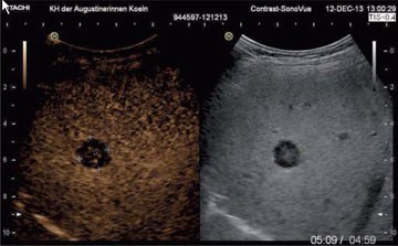 Abb. 2 Kontrastmittelsonographie beim isolierten Non-Hodgkin-Lymphom der Leber. Im rechten Teil ist das B-Bild, im linken das  korrespondierende Bild des gleichen Bereiches ca. 5 Minuten nach  Kontrastmittel-Applikation zu sehen (durch gelblich-goldene Pixels  visualisiert). Der rundliche Herd nimmt dieses im Vergleich zum um-liegenden Leberparenchym nicht an: Wash-out-Phänomen