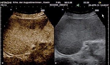 Abb. 3 Kontrastmittelsonographie der Milz beim Non-Hodgkin-Lym-phom. Im rechten Teil ist das B-Bild, im linken das korrespondierende Bild  des gleichen Bereiches ca. 3 Minuten nach Kontrastmittel-Applikation zu  sehen. Der dunkel imponierende (hypoechogene) schallkopfnahe Bereich  repräsentiert die Lymphominfiltration (hier bioptisch gesichert).