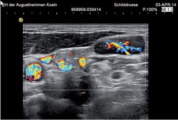 Abb. 4 Sonographie eines Halslymphknotens beim multizentrischen  Morbus Castleman (rechter Bildteil, linker Bildteil mit Gefäßanschnit-ten). Die Stellung der Erkrankung zwischen lymphoproliferetiv und  maligne wird durch die geodnete Gefäßarchitektur untermauert. Nach  Etoposid/ Rituximab kam es zur vollständigen Remission.