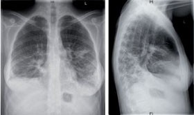 Abb.	1	Röntgenbild des Thorax (p.a. und seitlich) einer Patientin mit CVID, die bei fehlender  Adhärenz gegenüber der Immunglobulinsubstitution an rezidivierenden Pneumonien litt.