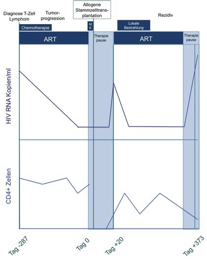 Abb. 2 Klinischer Verlauf „Essen Patienten“ (modifiziert nach  Kordelas et al.) ART: Antiretrovirale Therapie, MK: Myeloablative  Konditionierung