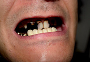 Meth-Zähne