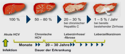 Abb. 1 Folgen einer chronischen Hepatitis C. Modifiziert nach: Lauer GM and Walker BD.  N Engl J Med 2001