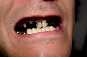 Schlechte Zähne