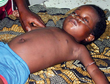 Abb. 1   Schwere Malaria tropica mit zerebralen  Komplikationen bei einem Kleinkind