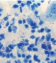 Abb. 4  Direktpräparat Urethritis durch N. gonorrhoeae (Methylenblaufärbung)