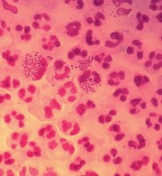 Gram-gefärbte Neisseria gonorrhoeae aus einem Harnröhrenabstrich © Wikipedia