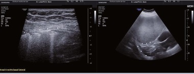 Abb 1  Fragmentierte Pleura (linkes Bild) und eine Konsolidierung mit positivem Aerobroncho-gramm (rechtes Bild) als typische sonographische Zeichen einer COVID-19 Pneumonie. (Reproduktion mit freundlicher Genehmigung von PD Dr. K. Stock, Klinikum rechts der Isar München)