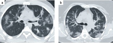 Abb 3   Patient mit Hodgkin-Lymphom (Bild a) und bestätigter Pneumocystis-Pneumonie sowie Patientin mit bestätigter COVID-19 Pneumonie (Bild b). In beiden CT Bildern sind ähnliche bipul-monale, teils milchglasartige, teils konsolidierte Areale zu sehen. (Reproduktion mit freundlicher Genehmigung von Dr. F. Lohöfer, Klinikum rechts der Isar München27)