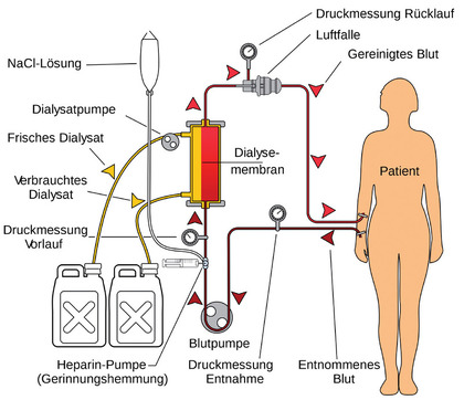 Schema einer Hämodialyse-Maschine
