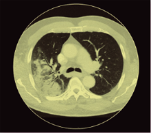 CT-Thorax eines HIV-infizierten Patienten mit Legionellenpneumonie