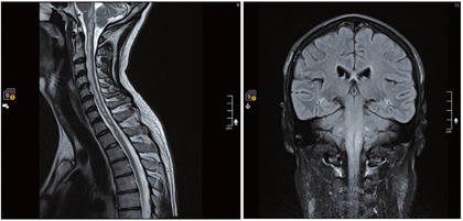 Abb. 1  MRT des Patienten: Befall des Hirnstamms und des Myelons bei PML (hell: hyperintense Areale)