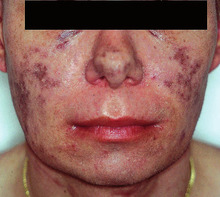 Abb. 1 Kutanes Kaposi-Sarkom im Gesicht mit charakteristischem Ödem der Gesichtshaut