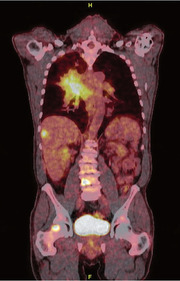 PET-CT: Patient mit Bronchial- karzinom mit hepatischer und ossärer Metastasierung