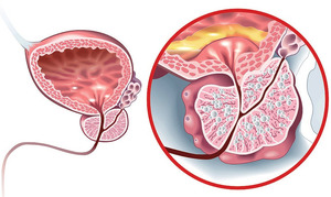 Abb. 1 Benignes Prostataadenom