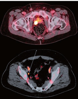 Abb. 2  PSMA-PET-CTs mit vermehrter PSMA-Expression in der Prostata (oben) und einem suspekten Lymphknoten (unten)