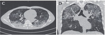 Abb. 3 C+D  CT-Thoraxaufnahmen eines spät diagnostizierten Menschen mit  HIV, am Tag 18 nach Beginn der Therapie einer Pneumocystis  jiroveci-Pneumonie und Tag 8 nach ART-Start und bei nun erneuter klinischer Beschwerdesymptomatik: neue diffuse beidseitige Oberfeld-Infiltrate (C + D)