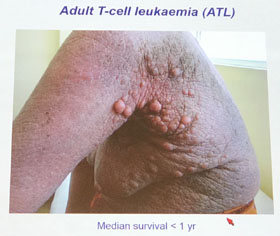 Adult T-Cell Leukemia