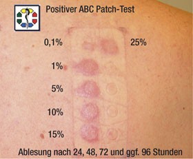 Positiver ABC Patch-Test